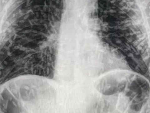 Xem ảnh X-quang của bệnh nhân bị ho, bác sĩ phát hiện 'thủ phạm' đáng sợ