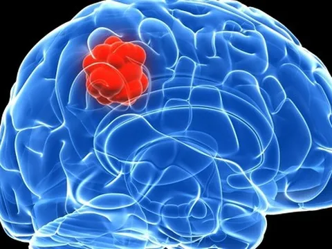 Người phụ nữ phát hiện u não từ dấu hiệu bất thường khi ngủ dậy