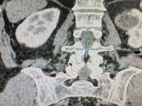Người đàn ông phát hiện ung thư thận sau khi có dấu hiệu bất thường này suốt 6 tháng
