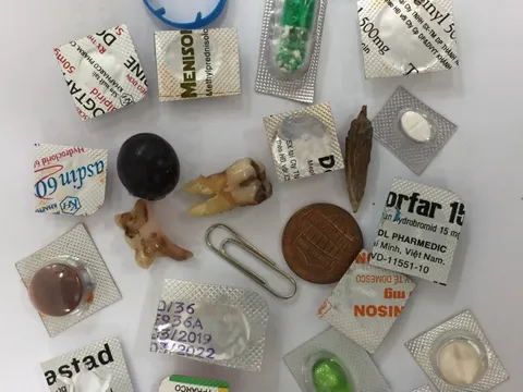 Bác sĩ nội soi sửng sốt vì một "đống rác hỗn độn" trong bao tử nam thanh niên