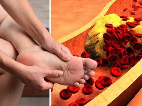 Dấu hiệu ‘kỳ lạ’ ở ngón chân cảnh báo mỡ máu đang tăng cao