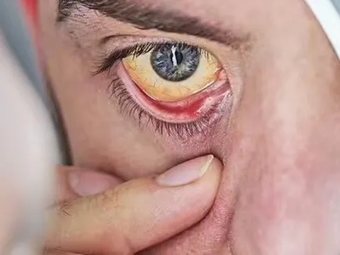 Bác sĩ lên truyền hình, cảnh báo 2 dấu hiệu ở mắt có thể ‘gióng lên hồi chuông cảnh báo’ bệnh tật