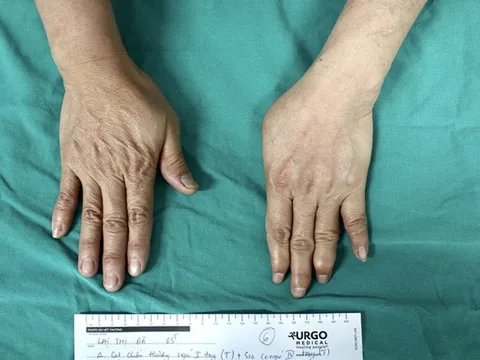 Bàn tay được ghép từ ngón chân vẫn cử động, cầm nắm được mọi thứ