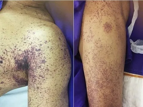 Người đàn ông ở Hà Nội tử vong sau vài ngày giết mổ lợn