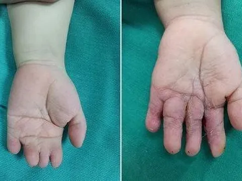 Phẫu thuật tách thành công 4 ngón tay bị dính bẩm sinh của trẻ 4 tuổi