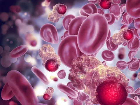 Cảnh báo: Điều nhiều người "xem nhẹ" có thể kích hoạt ung thư máu