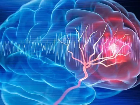 Nắng nóng, đột quỵ "vào guồng": Các dấu hiệu dễ bị nhầm lẫn với say nắng