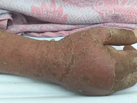 Người đàn ông suy gan, thận do dị ứng thuốc kháng lao