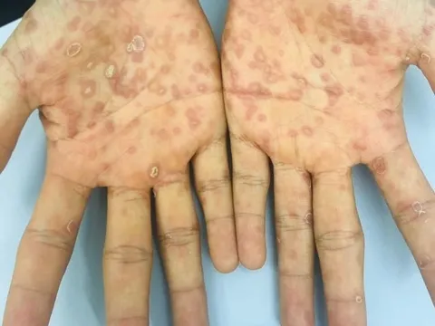 Dấu hiệu nhận biết giang mai ác tính