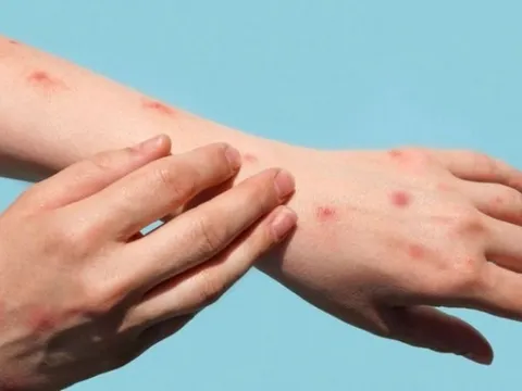 Bố tử vong khi mới 32 tuổi sau khi lây thủy đậu từ con nhỏ