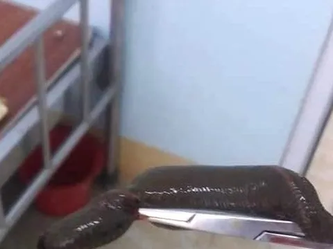 Bị đỉa dài 15cm chui vào dương vật