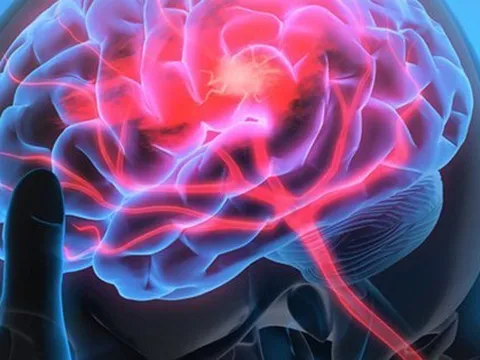 Nghiên cứu khoa học chỉ ra ‘thủ phạm’ hàng đầu của loại đột quỵ đang gia tăng ở người trẻ