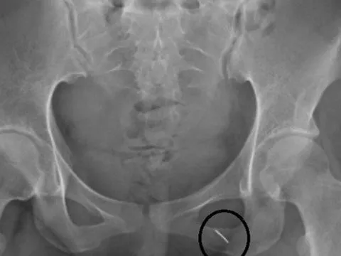 Phòng thượng mã phong cho chú rể, cô dâu bị kim đâm xuyên mông