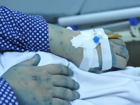 32 tuổi tử vong do mắc thuỷ đậu: Bác sĩ khuyến cáo điều thường bỏ qua