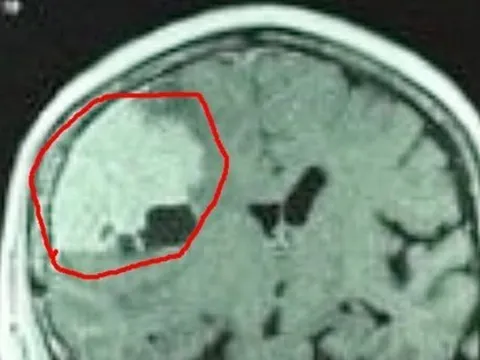 Đau đầu kéo dài vì khối u màng não 'khổng lồ'