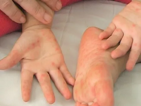 Một cháu bé tử vong vì bệnh tay chân miệng