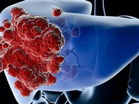 Đau 3 vùng này, coi chừng ung thư gan