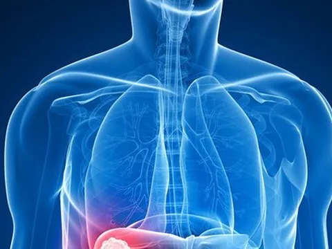 Đau tức hạ sườn bên phải, coi chừng u gan ác tính