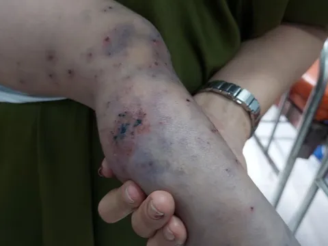 TP HCM: Một ca tử vong vì bệnh tay chân miệng