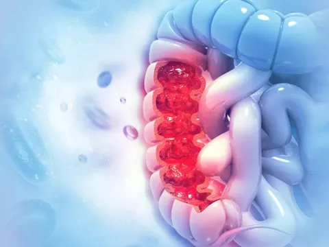 Ung thư ruột tăng 2,6 lần ở thanh thiếu niên: Lầm tưởng nguy hiểm
