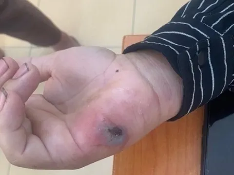 Điện Biên phát hiện 3 ổ dịch bệnh than trên người, Bộ Y tế vào cuộc