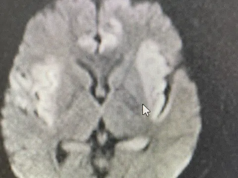 Viêm não virus - đừng chủ quan