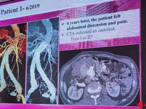 Cảnh giác với bệnh lý mạch máu