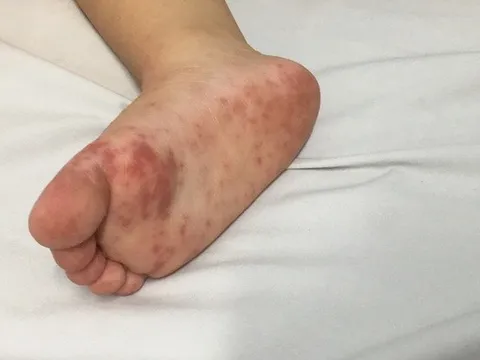 Làm sao sớm nhận biết trẻ mắc tay chân miệng độ nặng?