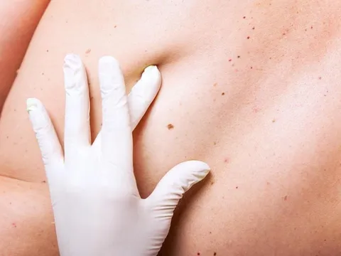 LƯU Ý: 5 bước tự phát hiện ung thư da