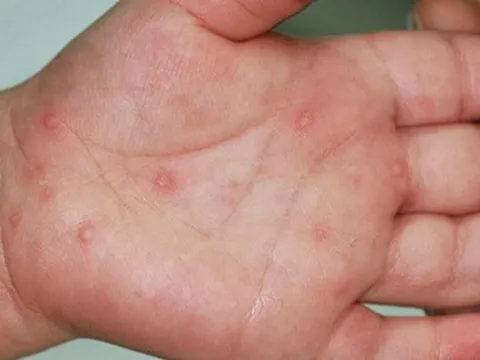 Ghi nhận gần 9.000 ca tay chân miệng, 3 trẻ em tử vong