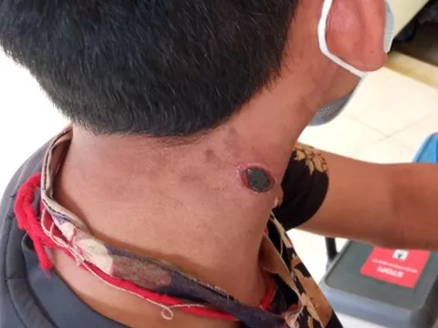 Khẩn trương ngăn chặn bệnh than