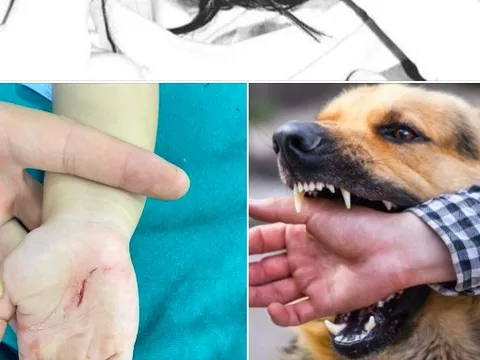 Bé 18 tháng tuổi bị chó cắn lộ xương sọ