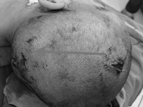 Bình ga mini trong đống rác phát nổ khiến bé gái hôn mê