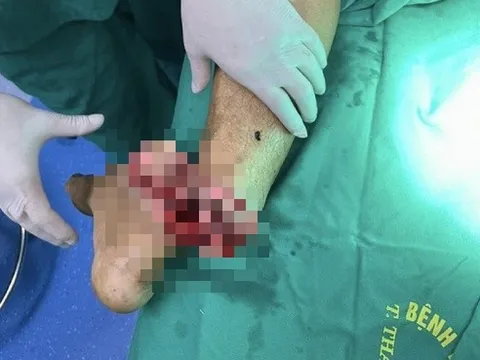 Bác sĩ xuyên đêm nối bàn chân người đàn ông bị cưa máy cắt đứt lìa