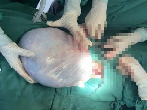 Phẫu thuật cắt khối u buồng trứng nặng gần 9kg cho bé gái 15 tuổi