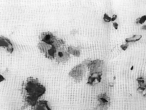 Nổ bình gas mini khiến bé gái 5 tuổi bị dập não