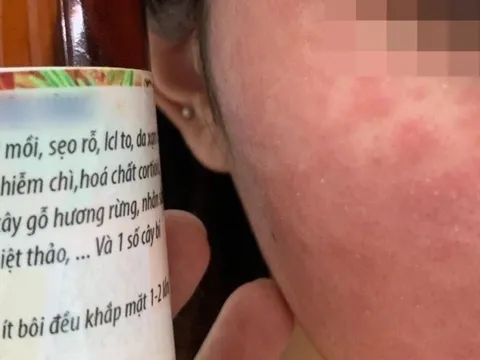 Mê làm đẹp bằng cách lột da, thiếu nữ Hà thành nhận kết đắng