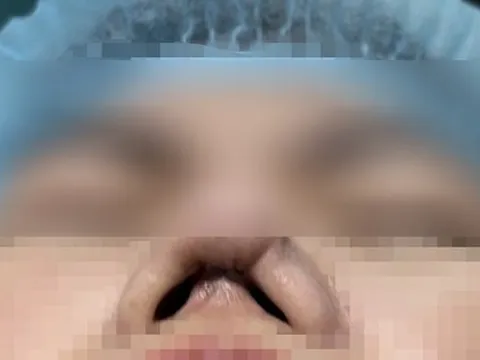 Hư mũi nặng sau nhiều lần thẩm mỹ