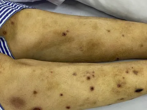 Mời thầy lang dùng ong châm trị đau chân tay, bệnh nhân đái tháo đường phải nhập viện vì đa biến chứng