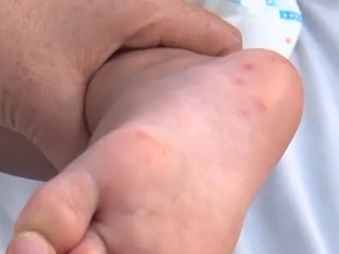 Tay chân miệng: nhận diện và chăm sóc trẻ mắc bệnh như thế nào?