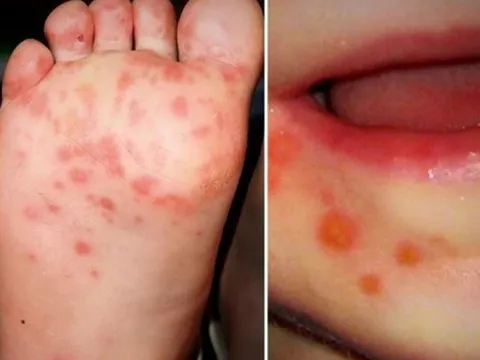 Tp.HCM: Đã có 4 ca tử vong do tay chân miệng