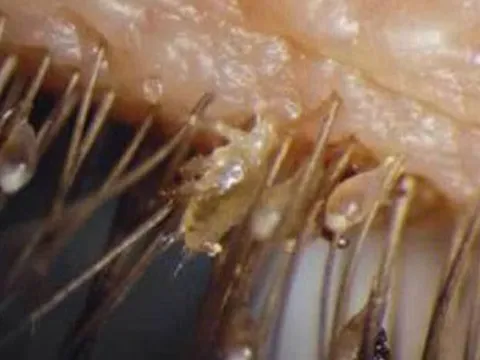 Mắt đỏ, ngứa, khó chịu, đi khám phát hiện 100 'thủ phạm' đáng sợ ở mi mắt