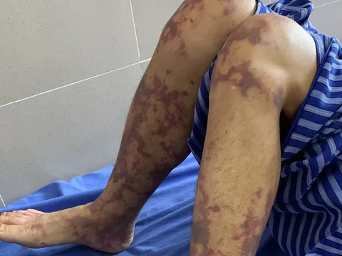 Người đàn ông nguy kịch do nhiễm liên cầu lợn từ thói quen ăn tiết canh