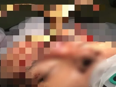 Rút thanh sắt cắm giữa trán, cứu sống người đàn ông đang nguy kịch