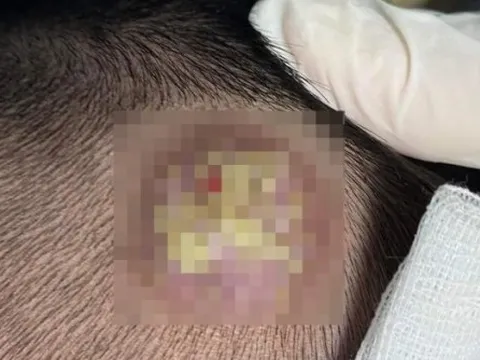 Thường xuyên ngủ chung với chó, mèo, 2 thành viên trong gia đình bị bệnh lạ ở vùng da đầu