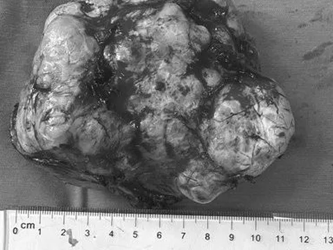 Đi mổ ruột thừa, phát hiện khối u ác tính "khủng" làm xẹp phổi trái