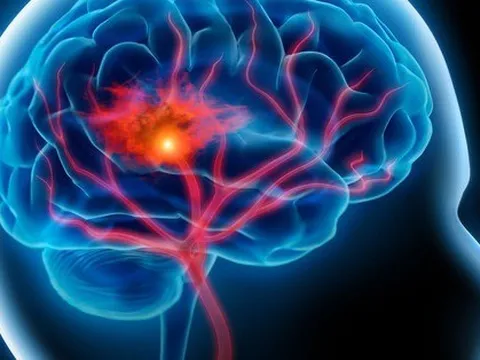 Tập thể dục rất dễ gây đột quỵ ở người mắc bệnh này: Những dấu hiệu đột quỵ nhất định phải biết