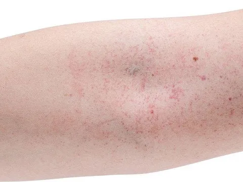 Ho do sốt xuất huyết: Chớ chủ quan