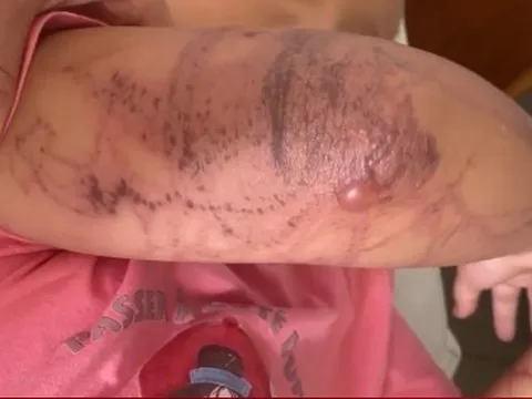 Bị sứa đốt khi tắm biển, bé 7 tuổi nhập viện trong tình trạng mất ý thức