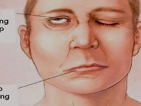 Miệng méo, mắt không nhắm kín do tắm ngay khi tập thể dục buổi sáng